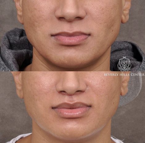 Modified Upper Lip Lift with Deep Plane Release - Front