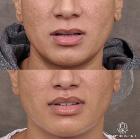 Modified Upper Lip Lift with Deep Plane Release - Front