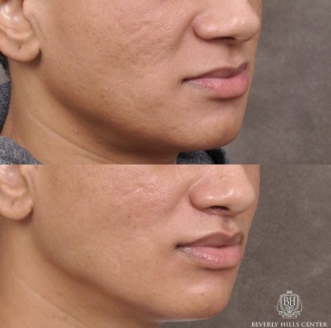Modified Upper Lip Lift with Deep Plane Release - Right Side
