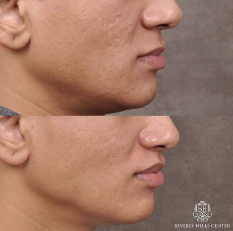 Modified Upper Lip Lift with Deep Plane Release - Right Side