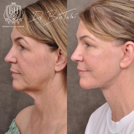 Beverly Hills Center Female Patient Before and After AuraLyft and Brow Lift