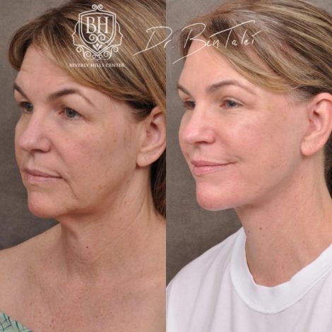 Beverly Hills Center Female Patient Before and After AuraLyft and Brow Lift