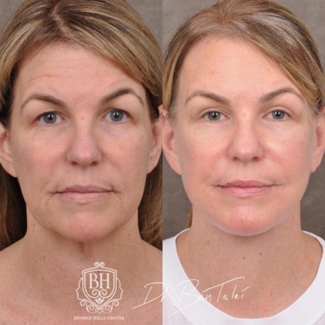 Beverly Hills Center Female Patient Before and After AuraLyft and Brow Lift
