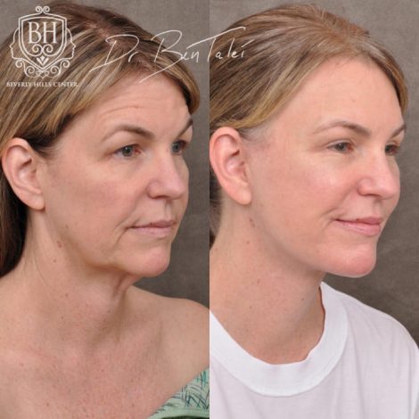 Beverly Hills Center Female Patient Before and After AuraLyft and Brow Lift