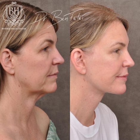 Beverly Hills Center Female Patient Before and After AuraLyft and Brow Lift