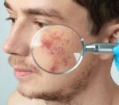 A young man having acne scars examined by a cosmetic surgeon in Beverly Hills, CA.