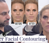 Fyller Facial Contouring Before After - youtube cover