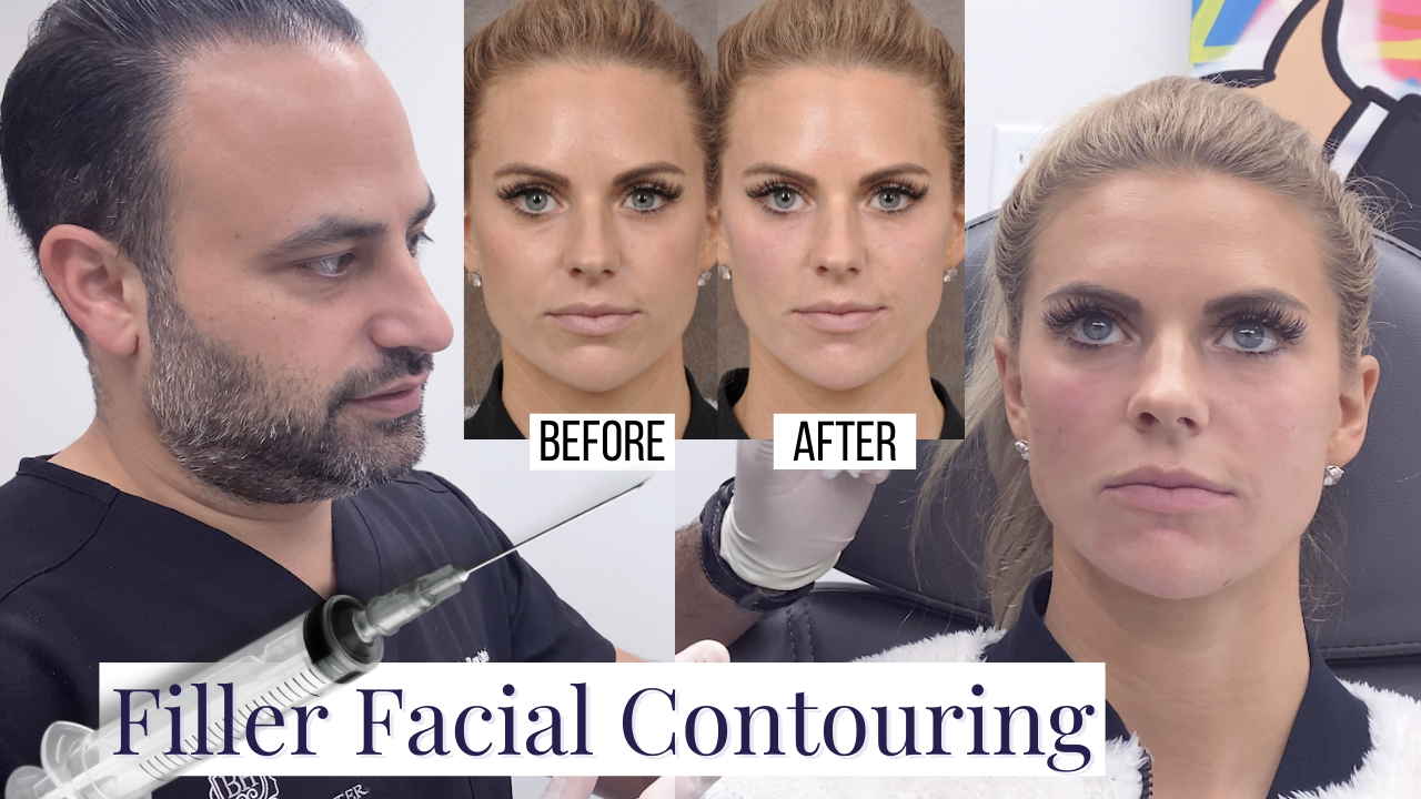 Fyller Facial Contouring Before After - youtube cover