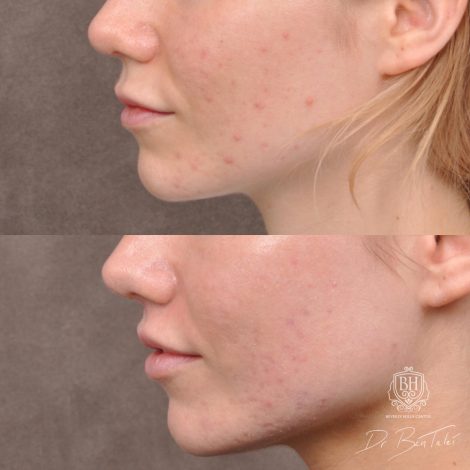 Beverly Hills Center Female Patient Before and After 5mm Deep Plane Modified Upper Lip Lift