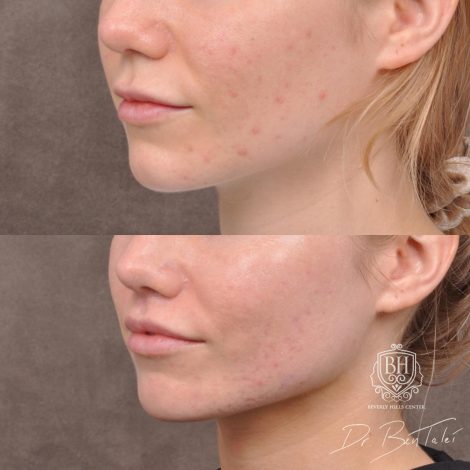 Beverly Hills Center Female Patient Before and After 5mm Deep Plane Modified Upper Lip Lift