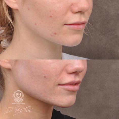 Beverly Hills Center Female Patient Before and After 5mm Deep Plane Modified Upper Lip Lift