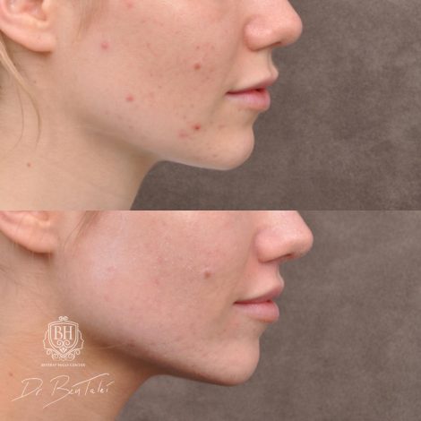 Beverly Hills Center Female Patient Before and After 5mm Deep Plane Modified Upper Lip Lift