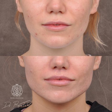 Beverly Hills Center Female Patient Before and After 5mm Deep Plane Modified Upper Lip Lift