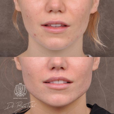 Beverly Hills Center Female Patient Before and After 5mm Deep Plane Modified Upper Lip Lift