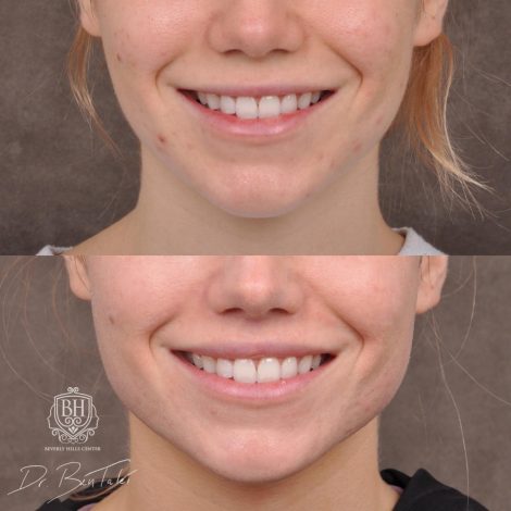 Beverly Hills Center Female Patient Before and After 5mm Deep Plane Modified Upper Lip Lift