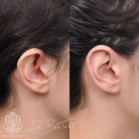 Beverly Hills Center Female Patient Before and After 2 Weeks Post Otoplasty