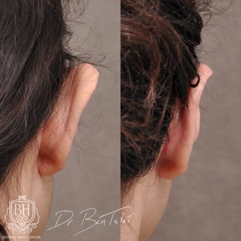 Beverly Hills Center Female Patient Before and After 2 Weeks Post Otoplasty
