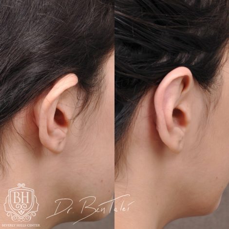 Beverly Hills Center Female Patient Before and After 2 Weeks Post Otoplasty