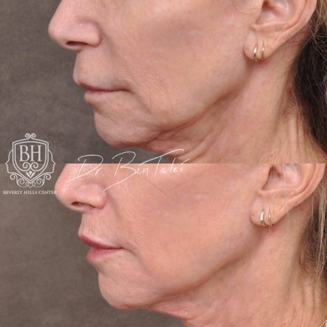 Beverly Hills Center Female Patient Before and After Modified Upper Lip Lift and Corner Lifts with CO2