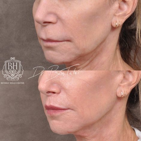 Beverly Hills Center Female Patient Before and After Modified Upper Lip Lift and Corner Lifts with CO2