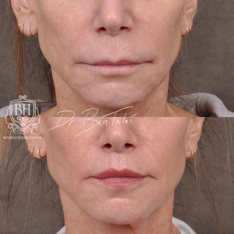 Beverly Hills Center Female Patient Before and After Modified Upper Lip Lift and Corner Lifts with CO2