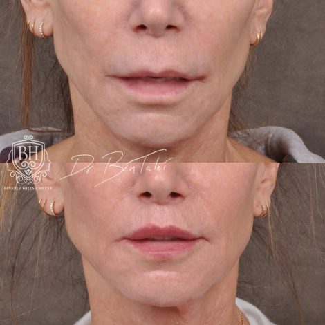 Beverly Hills Center Female Patient Before and After Modified Upper Lip Lift and Corner Lifts with CO2