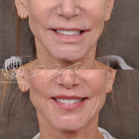 Beverly Hills Center Female Patient Before and After Modified Upper Lip Lift and Corner Lifts with CO2
