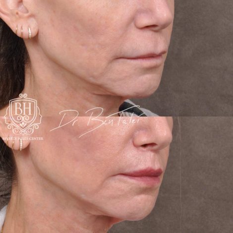 Beverly Hills Center Female Patient Before and After Modified Upper Lip Lift and Corner Lifts with CO2