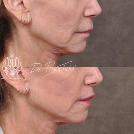 Beverly Hills Center Female Patient Before and After Modified Upper Lip Lift and Corner Lifts with CO2