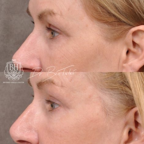 Beverly Hills Center Female Patient Before and After Laser Damage Deflation Repair - Comprehensive Aura-Lyft