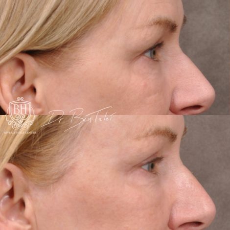 Beverly Hills Center Female Patient Before and After Laser Damage Deflation Repair - Comprehensive Aura-Lyft