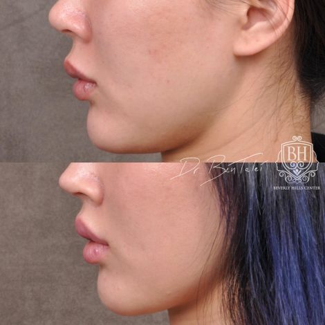 Beverly Hills Center Female Patient Before and After Deep Plane Upper Lip Lift