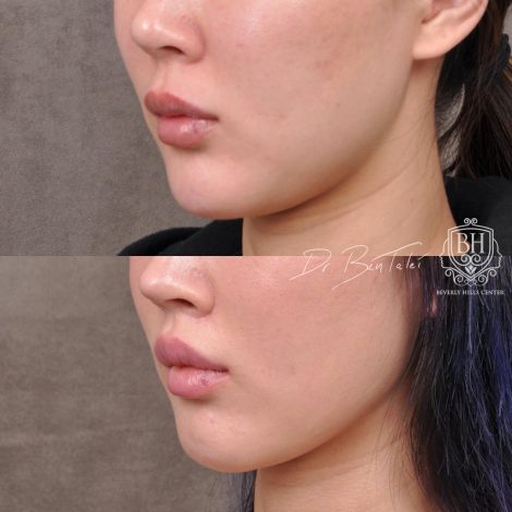 Beverly Hills Center Female Patient Before and After Deep Plane Upper Lip Lift