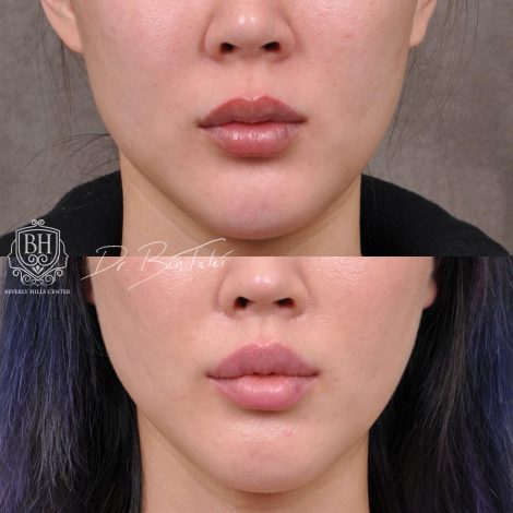 Beverly Hills Center Female Patient Before and After Deep Plane Upper Lip Lift
