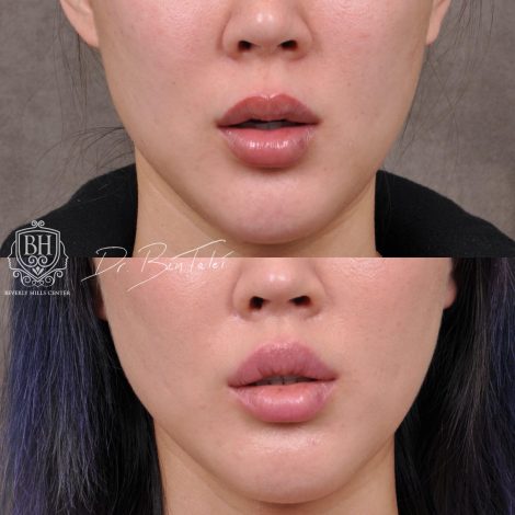 Beverly Hills Center Female Patient Before and After Deep Plane Upper Lip Lift