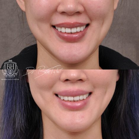 Beverly Hills Center Female Patient Before and After Deep Plane Upper Lip Lift