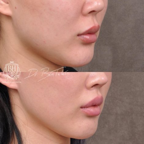 Beverly Hills Center Female Patient Before and After Deep Plane Upper Lip Lift