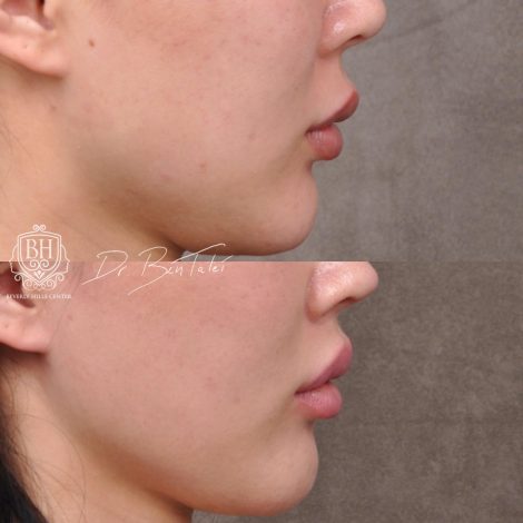 Beverly Hills Center Female Patient Before and After Deep Plane Upper Lip Lift