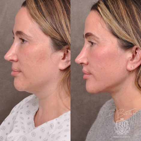 Beverly Hills Center Female Patient Before and After Weekend Neck Lift, Dissolved Filler, Upper Lip Lift Procedure