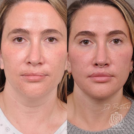 Beverly Hills Center Female Patient Before and After Weekend Neck Lift, Dissolved Filler, Upper Lip Lift Procedure