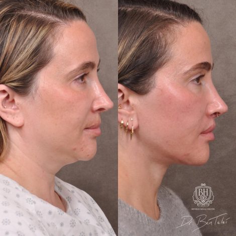 Beverly Hills Center Female Patient Before and After Weekend Neck Lift, Dissolved Filler, Upper Lip Lift Procedure