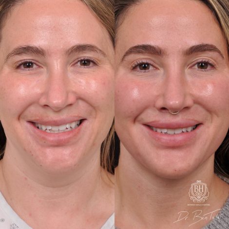 Beverly Hills Center Female Patient Before and After Weekend Neck Lift, Dissolved Filler, Upper Lip Lift Procedure