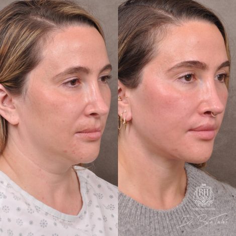 Beverly Hills Center Female Patient Before and After Weekend Neck Lift, Dissolved Filler, Upper Lip Lift Procedure