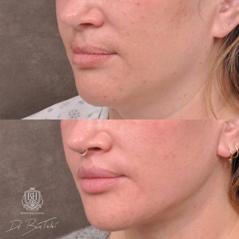 Beverly Hills Center Female Patient Before and After Dissolved Filler, Upper Lip Lift, Weekend Neck Lift Procedure