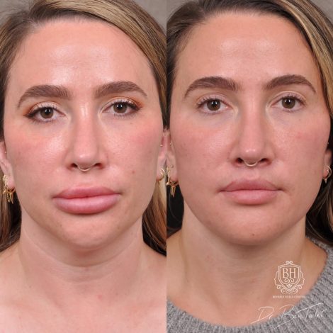 Beverly Hills Center Female Patient Before and After Weekend Neck Lift, Dissolved Filler, Upper Lip Lift Procedure