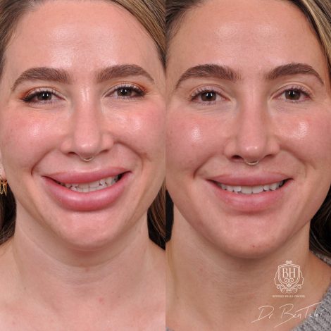 Beverly Hills Center Female Patient Before and After Weekend Neck Lift, Dissolved Filler, Upper Lip Lift Procedure