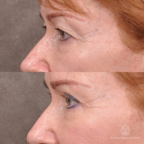 Beverly Hills Center Female Patient Before and After Upper Blepharoplasty with Fat Repositioning and Contouring