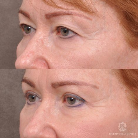 Beverly Hills Center Female Patient Before and After Upper Blepharoplasty with Fat Repositioning and Contouring