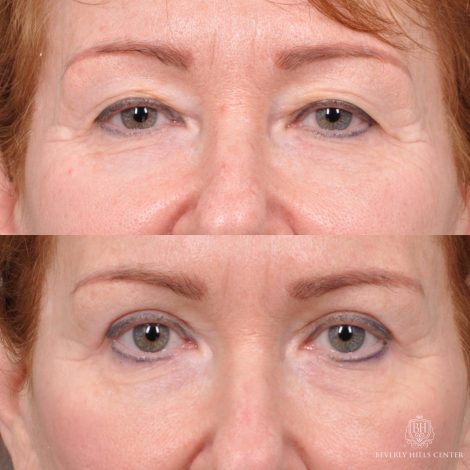 Beverly Hills Center Female Patient Before and After Upper Blepharoplasty with Fat Repositioning and Contouring