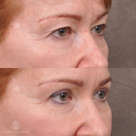Beverly Hills Center Female Patient Before and After Upper Blepharoplasty with Fat Repositioning and Contouring